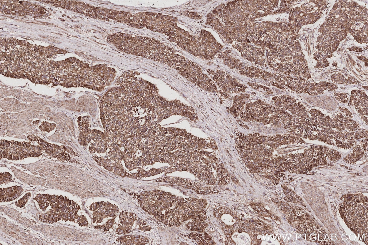 Immunohistochemical analysis of paraffin-embedded human stomach cancer tissue slide using KHC3055 (USP20 IHC Kit). Immunohistochemical analysis of paraffin-embedded human stomach cancer tissue slide using KHC3055 (USP20 IHC Kit).