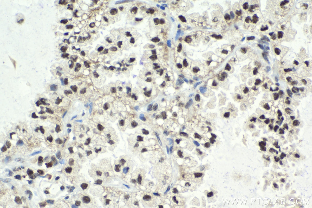 Immunohistochemical analysis of paraffin-embedded human lung cancer tissue slide using KHC2009 (USP22 IHC Kit).