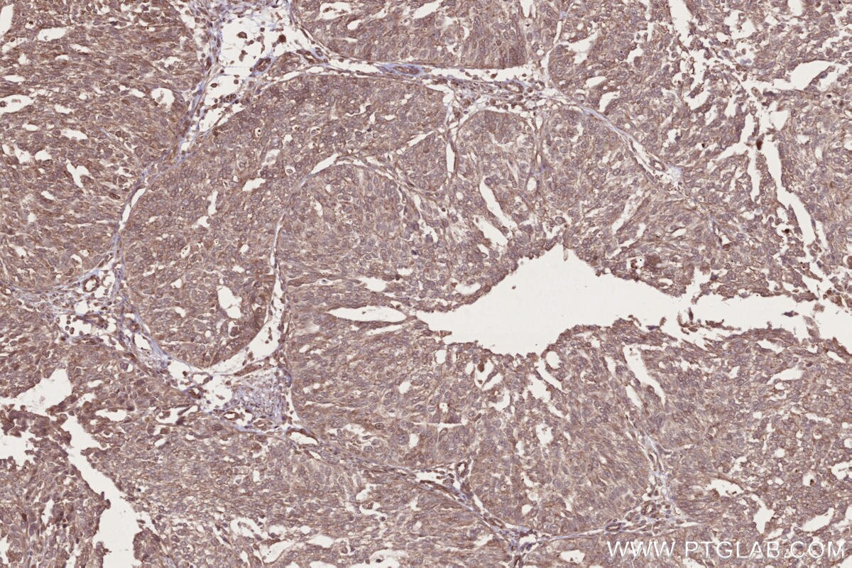 Immunohistochemical analysis of paraffin-embedded human ovary cancer tissue slide using KHC2685 (USP38 IHC Kit).