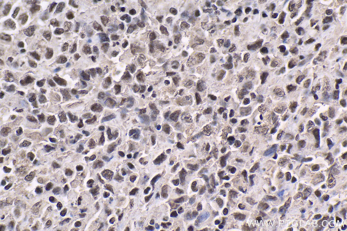 Immunohistochemical analysis of paraffin-embedded human malignant melanoma tissue slide using KHC1863 (USP7 IHC Kit).