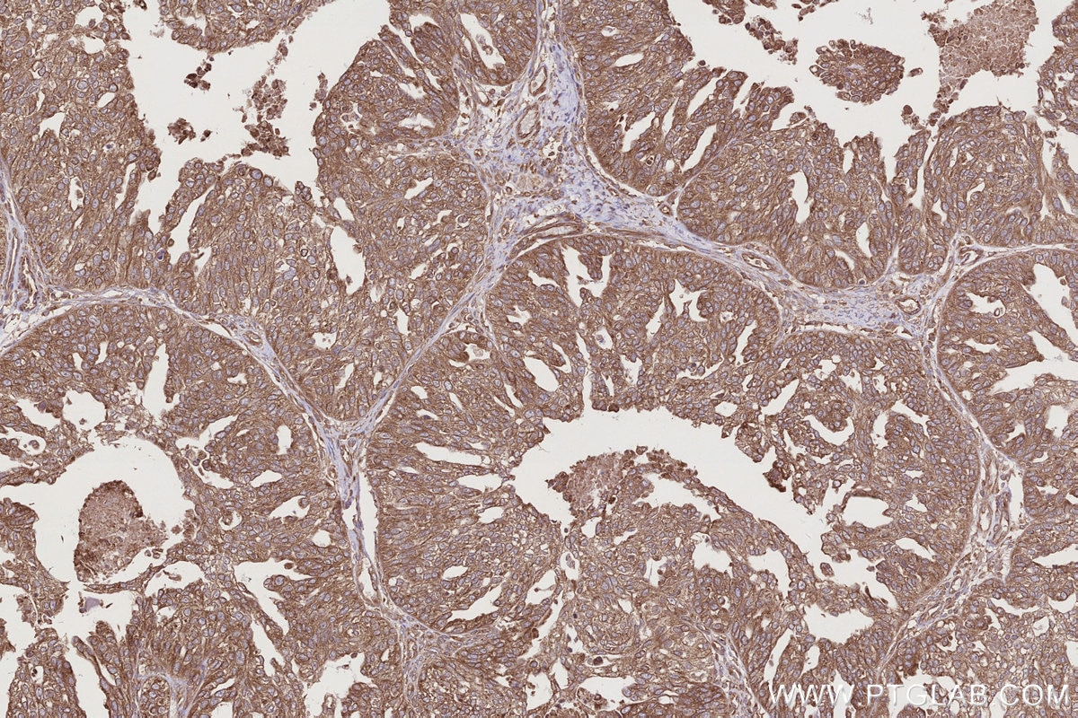 Immunohistochemical analysis of paraffin-embedded human ovary cancer tissue slide using KHC2770 (USP9X IHC Kit).