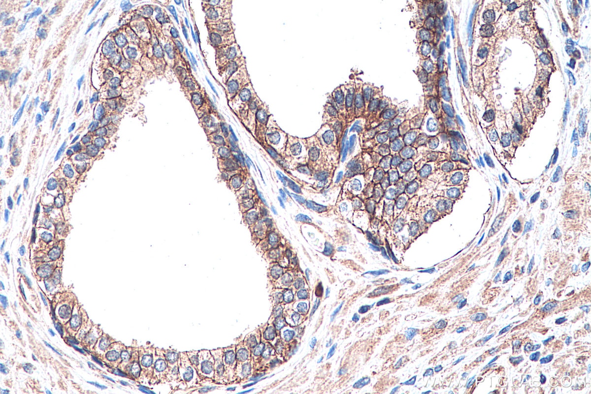 Immunohistochemical analysis of paraffin-embedded human prostate cancer tissue slide using KHC0289 (Utrophin IHC Kit).