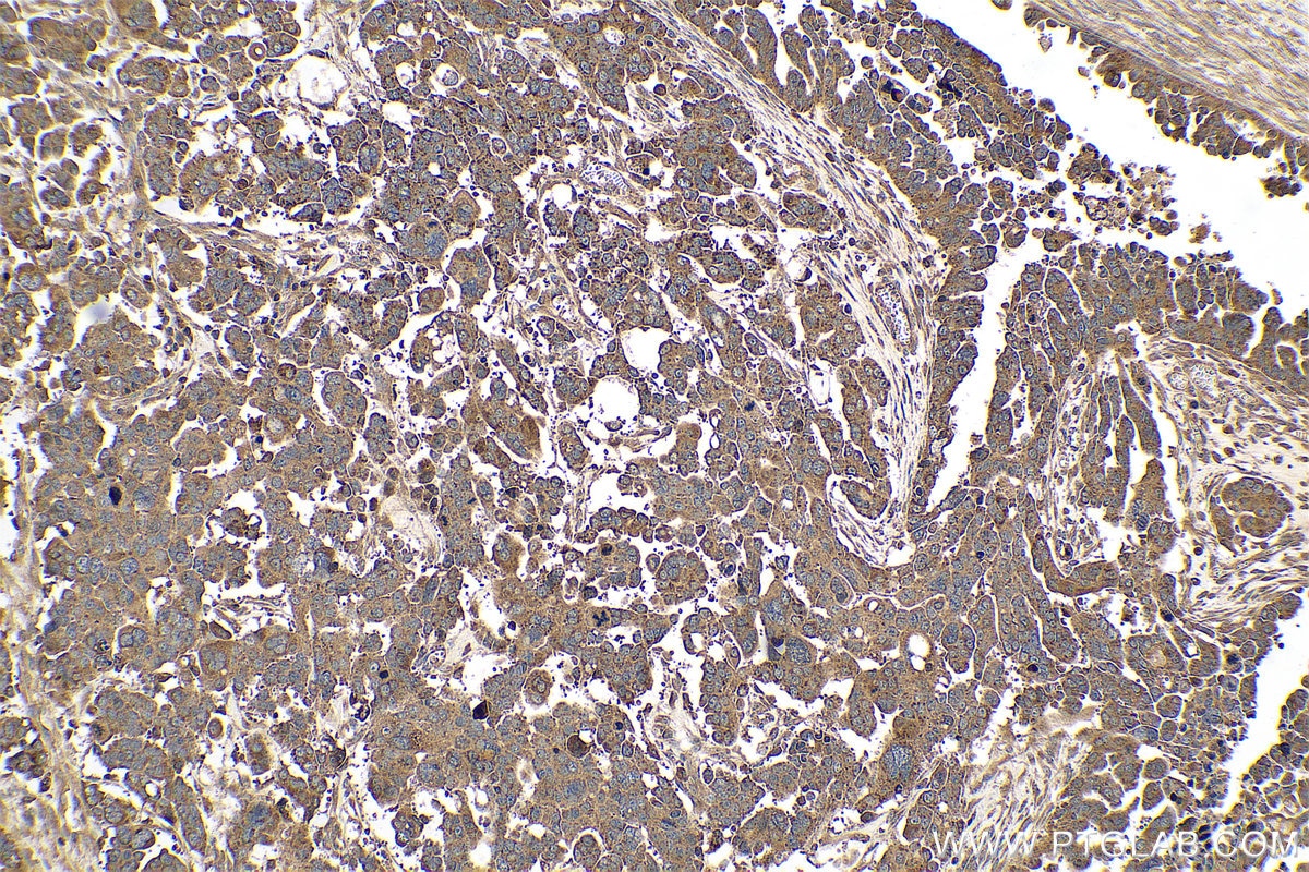 Immunohistochemical analysis of paraffin-embedded human colon cancer tissue slide using KHC0784 (VAC14 IHC Kit).