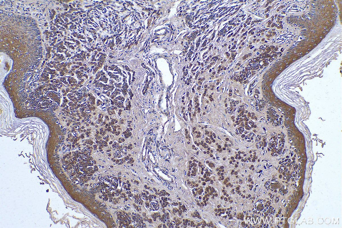 Immunohistochemical analysis of paraffin-embedded human malignant melanoma tissue slide using KHC0784 (VAC14 IHC Kit).