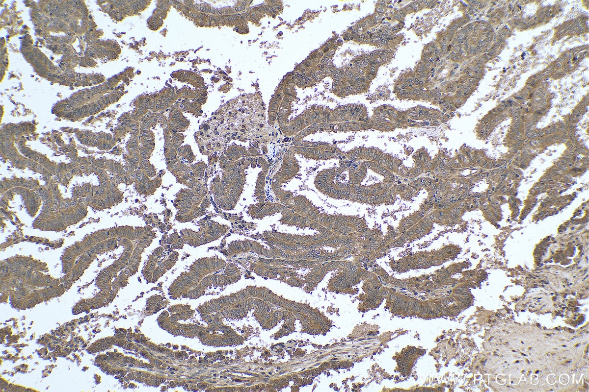 Immunohistochemical analysis of paraffin-embedded human ovary tumor tissue slide using KHC0784 (VAC14 IHC Kit).