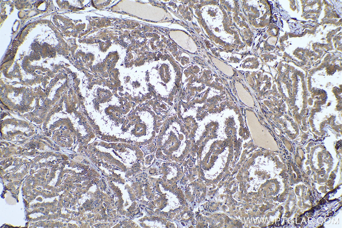 Immunohistochemical analysis of paraffin-embedded human thyroid cancer tissue slide using KHC0784 (VAC14 IHC Kit).