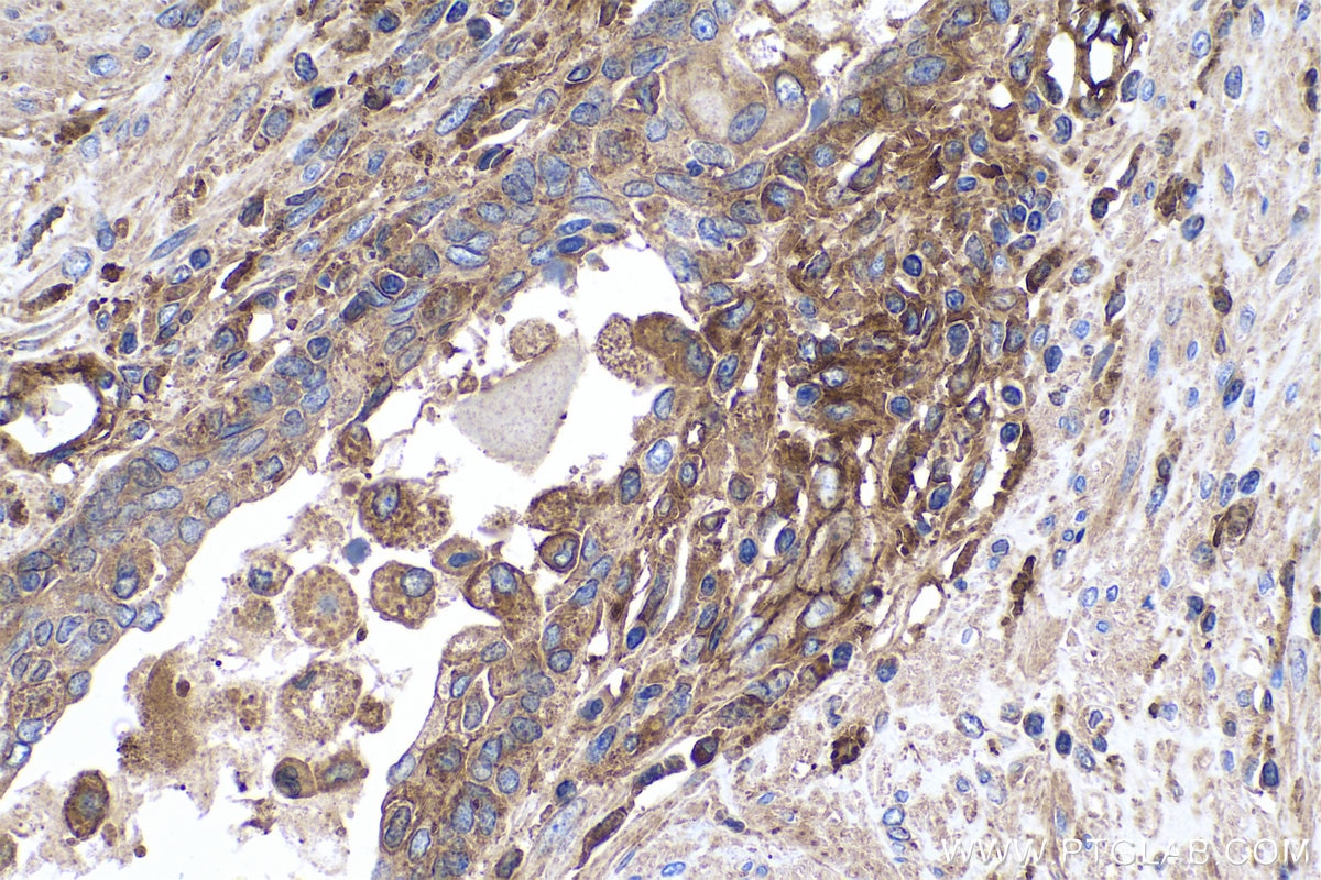Immunohistochemical analysis of paraffin-embedded human prostate cancer tissue slide using KHC0472 (VAMP5 IHC Kit).