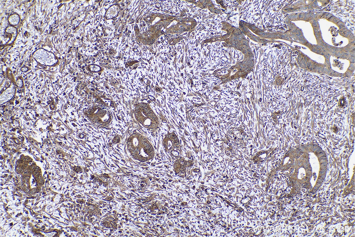 Immunohistochemical analysis of paraffin-embedded human colon cancer tissue slide using KHC0472 (VAMP5 IHC Kit).