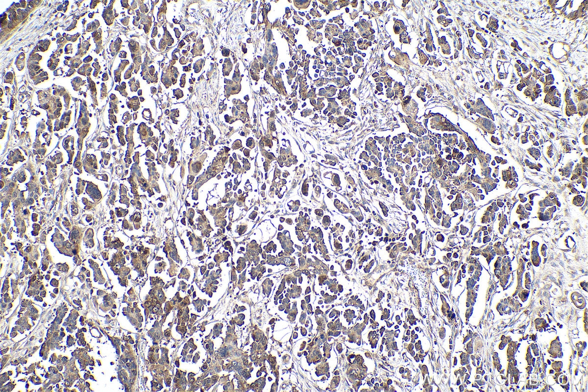 Immunohistochemical analysis of paraffin-embedded human colon cancer tissue slide using KHC0944 (VBP1 IHC Kit).