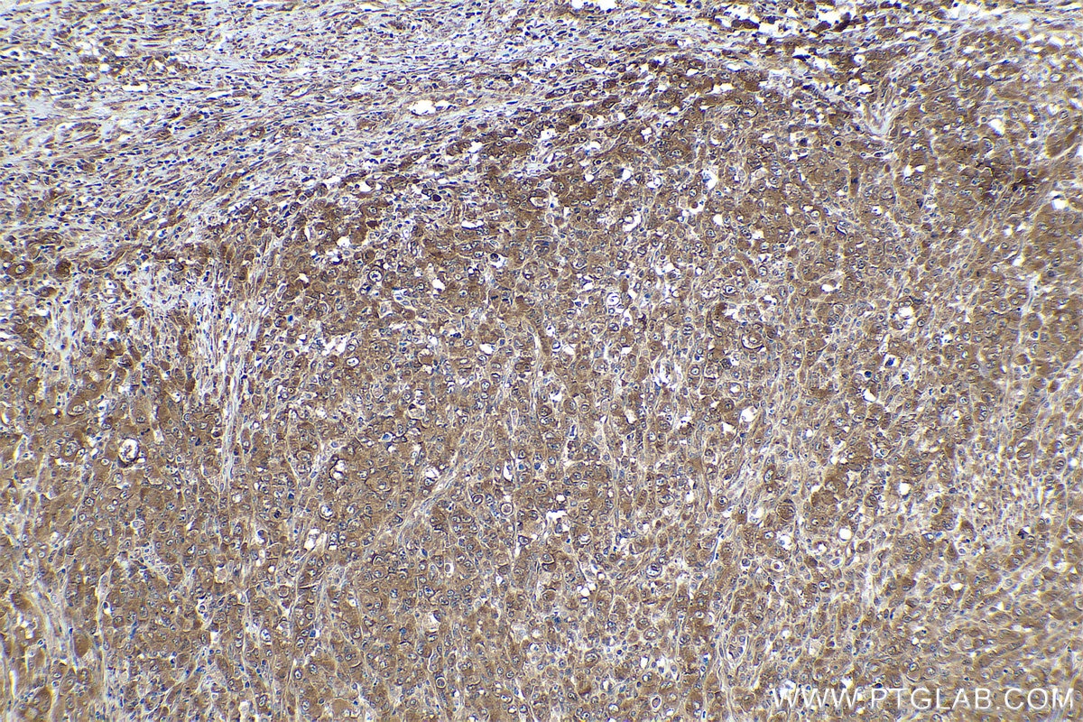 Immunohistochemical analysis of paraffin-embedded human lymphoma tissue slide using KHC0944 (VBP1 IHC Kit).