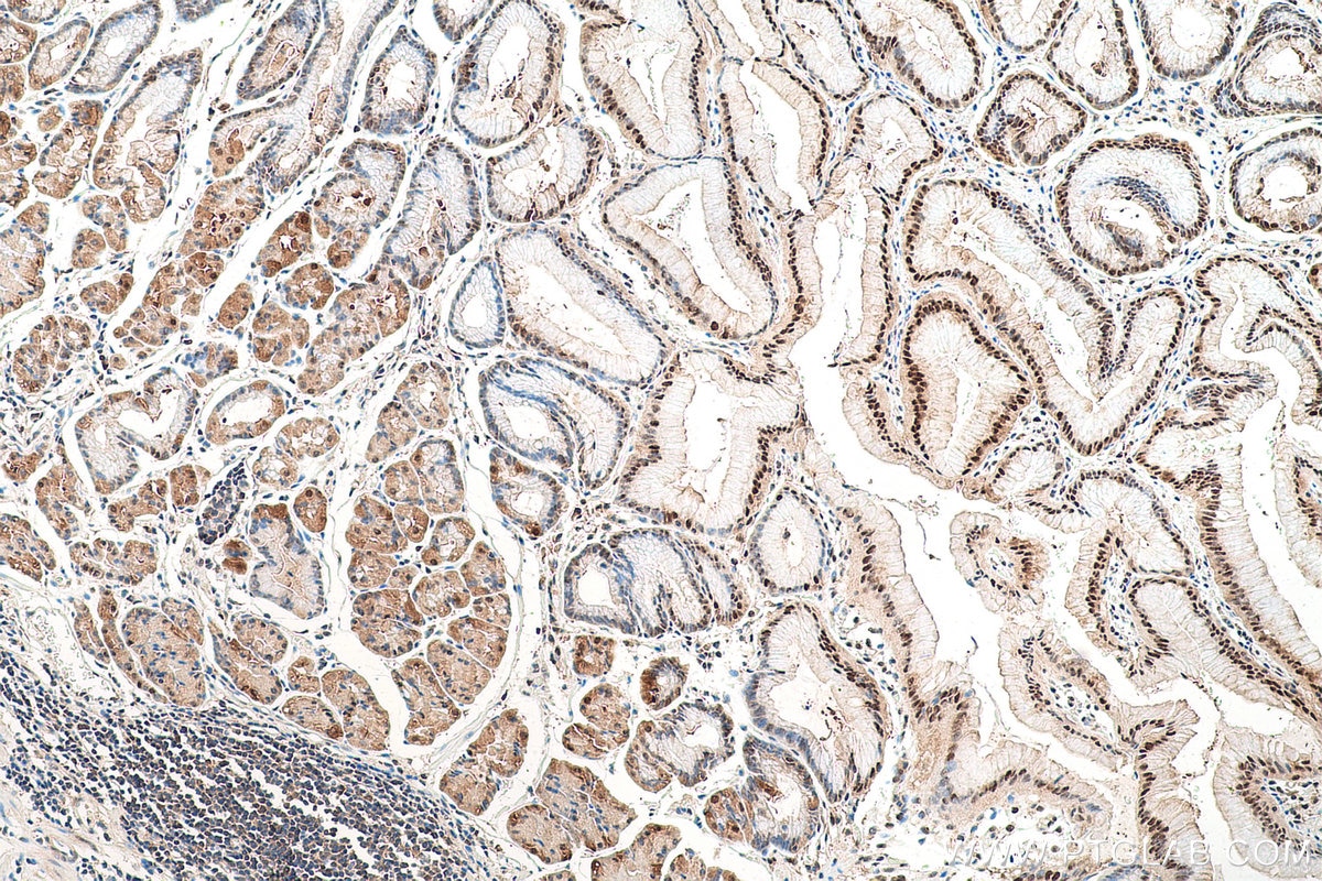 Immunohistochemical analysis of paraffin-embedded human stomach cancer tissue slide using KHC0830 (VCP IHC Kit).