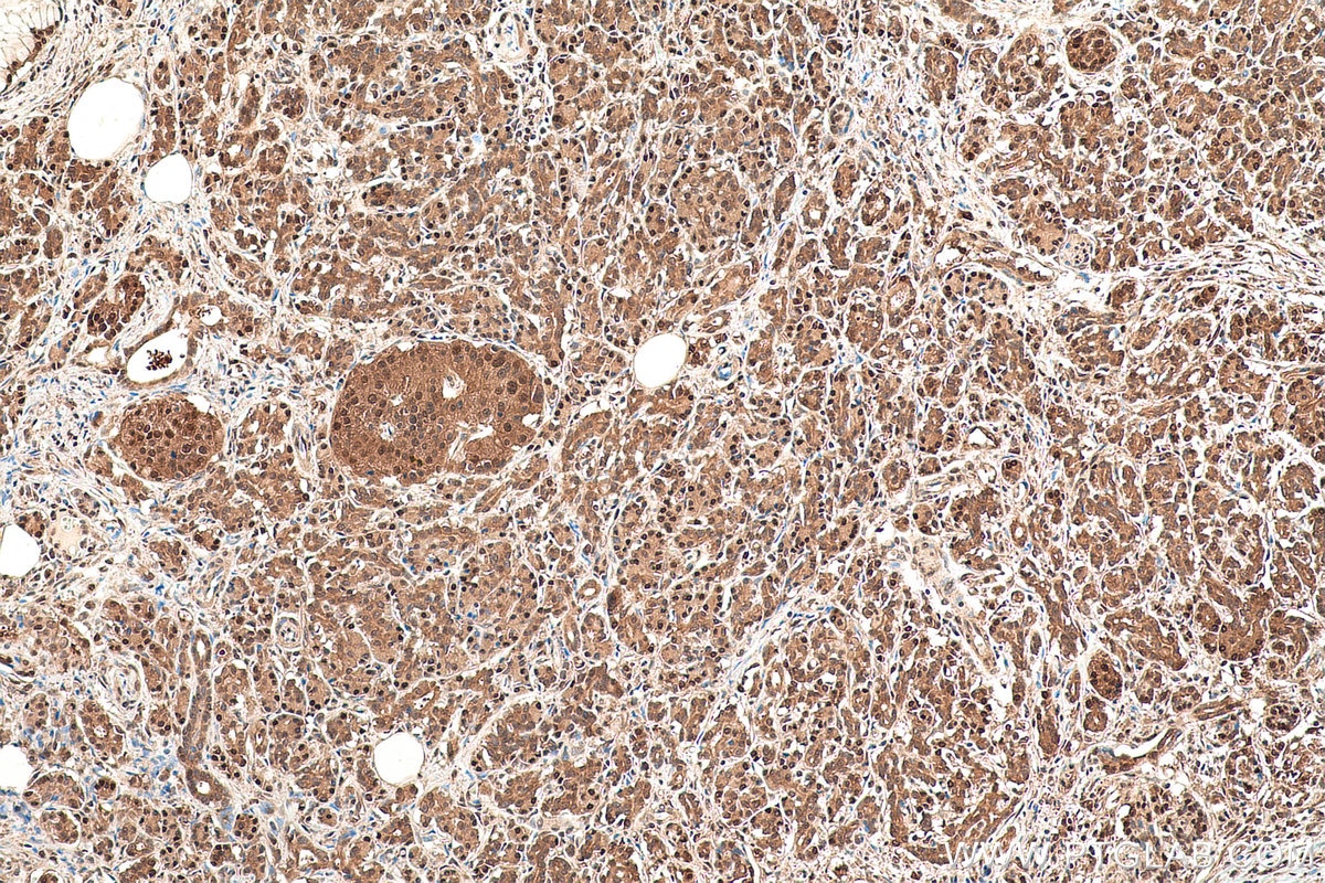 Immunohistochemical analysis of paraffin-embedded human pancreas cancer tissue slide using KHC0830 (VCP IHC Kit).