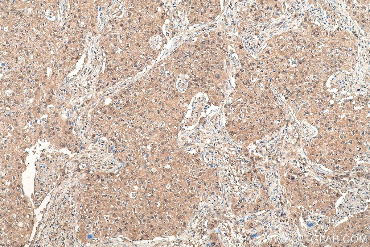 Immunohistochemical analysis of paraffin-embedded human lung cancer tissue slide using KHC0830 (VCP IHC Kit).