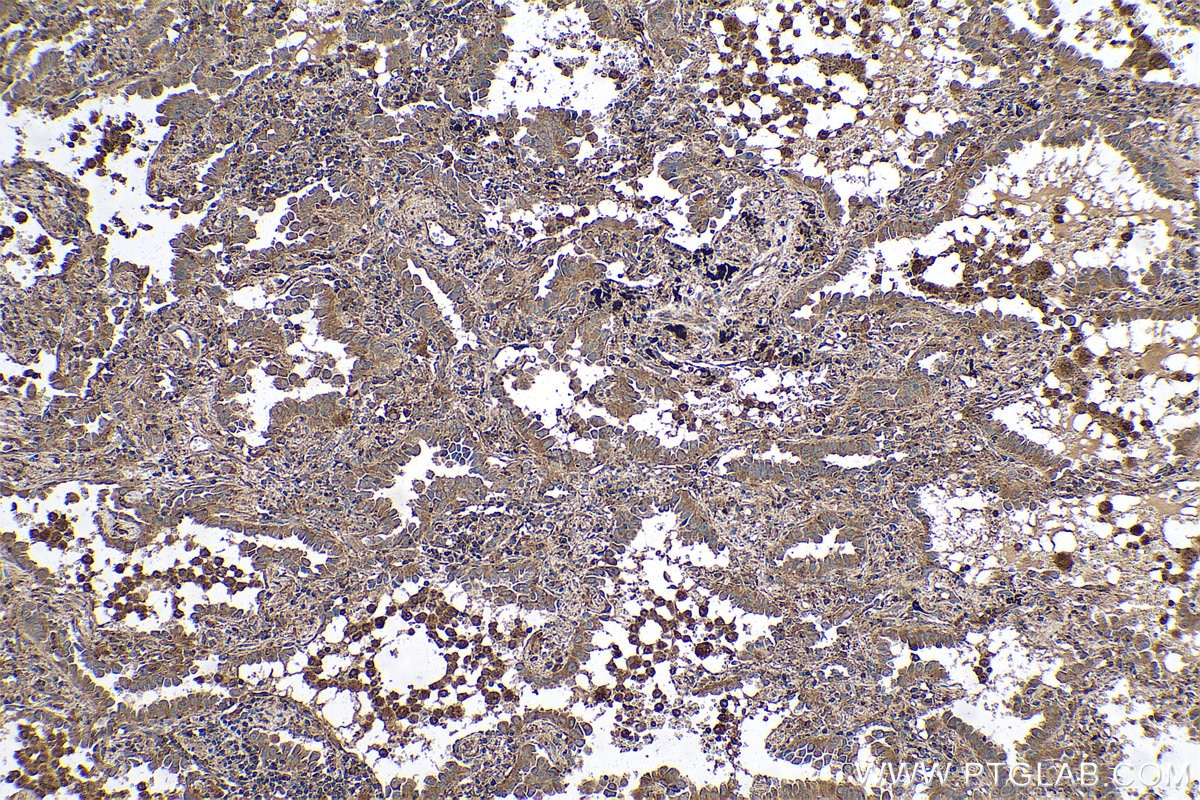 Immunohistochemical analysis of paraffin-embedded human lung cancer tissue slide using KHC0588 (VDAC1/2 IHC Kit).