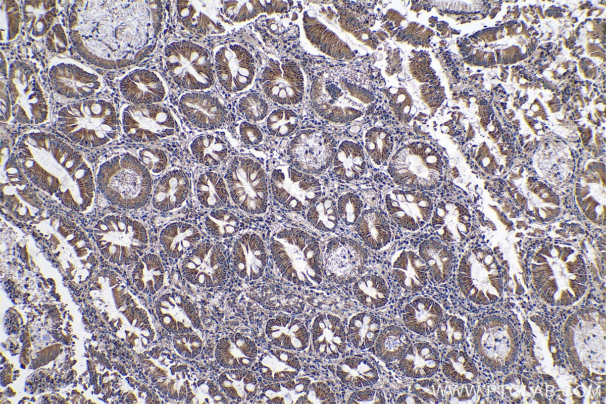 Immunohistochemical analysis of paraffin-embedded human stomach cancer tissue slide using KHC0588 (VDAC1/2 IHC Kit).