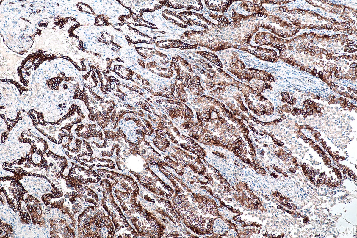 Immunohistochemical analysis of paraffin-embedded human lung cancer tissue slide using KHC0735 (VEGFA/VEGF IHC Kit).