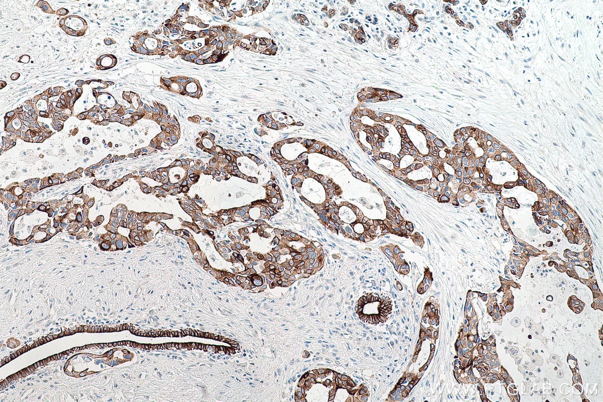 Immunohistochemical analysis of paraffin-embedded human pancreas cancer tissue slide using KHC0735 (VEGFA/VEGF IHC Kit).