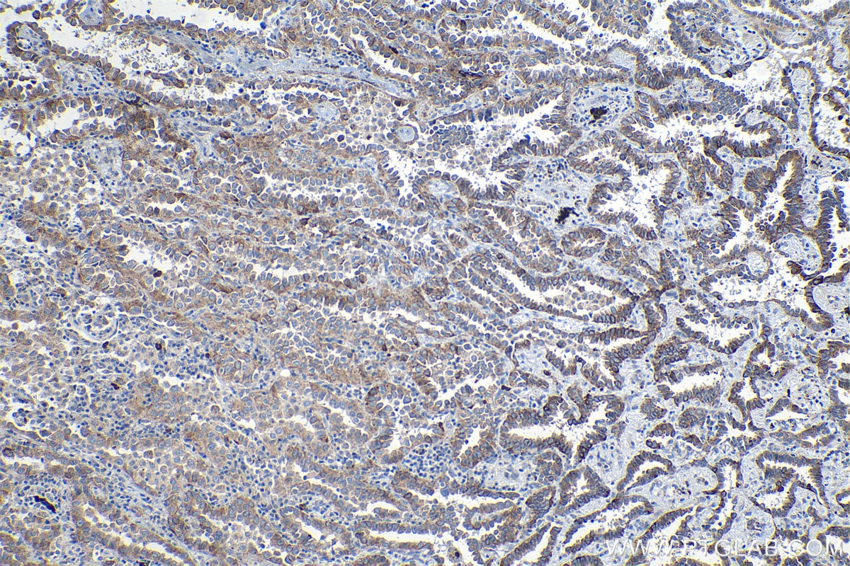 Immunohistochemical analysis of paraffin-embedded human lung cancer tissue slide using KHC1323 (VEGFC IHC Kit).