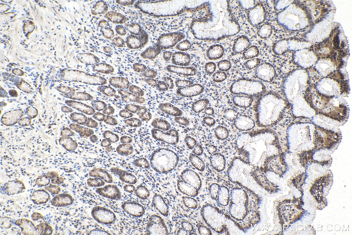 Immunohistochemical analysis of paraffin-embedded human stomach cancer tissue slide using KHC1592 (VHL IHC Kit).