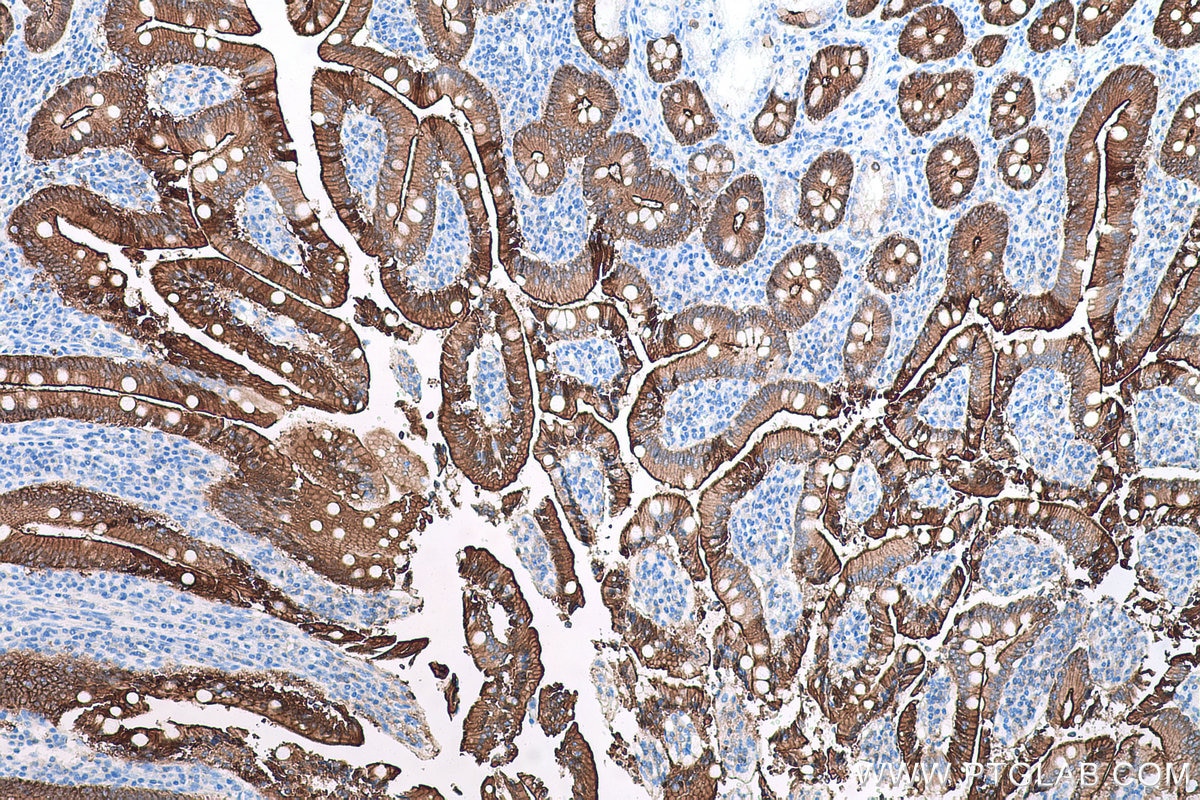 Immunohistochemical analysis of paraffin-embedded human stomach cancer tissue slide using KHC0601 (VIL1 IHC Kit).