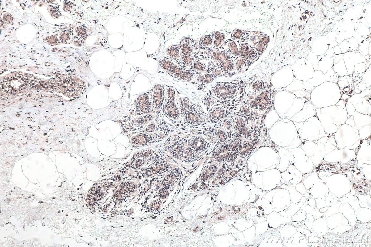 Immunohistochemical analysis of paraffin-embedded human breast cancer tissue slide using KHC0149 (VIRMA/KIAA1429 IHC Kit).