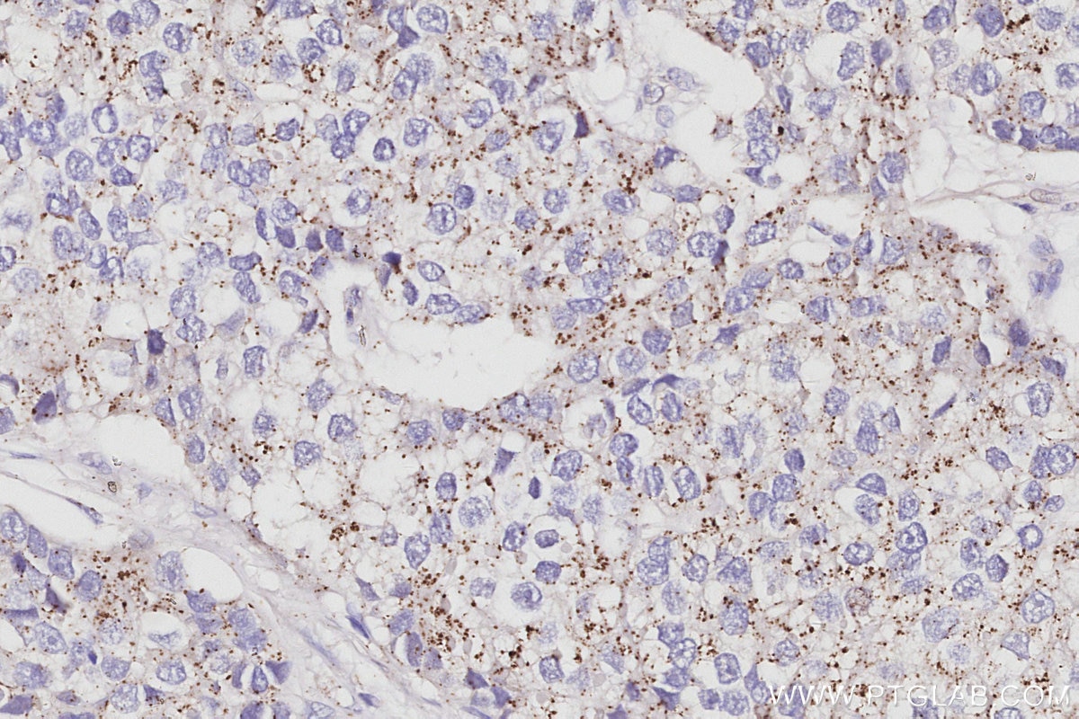 Immunohistochemical analysis of paraffin-embedded human stomach cancer tissue slide using KHC3062 (VPS24 IHC Kit). Immunohistochemical analysis of paraffin-embedded human stomach cancer tissue slide using KHC3062 (VPS24 IHC Kit).