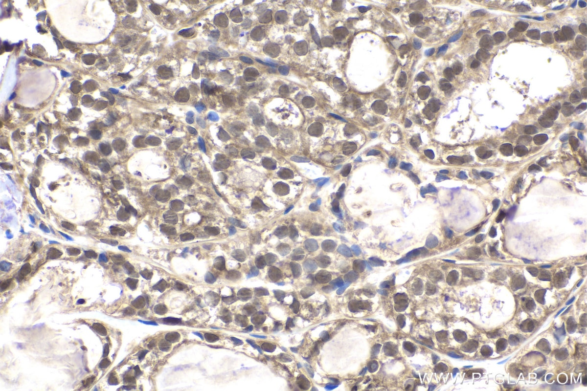 Immunohistochemical analysis of paraffin-embedded human thyroid cancer tissue slide using KHC1900 (VPS25 IHC Kit).
