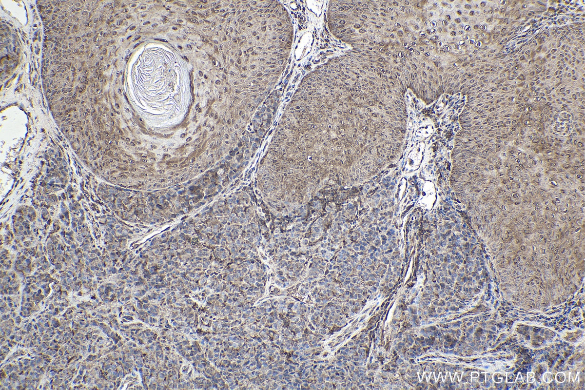 Immunohistochemical analysis of paraffin-embedded human malignant melanoma tissue slide using KHC1900 (VPS25 IHC Kit).