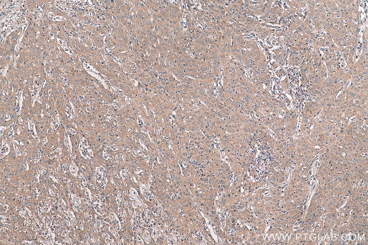 Immunohistochemical analysis of paraffin-embedded human cervical cancer tissue slide using KHC0961 (VPS26A IHC Kit).