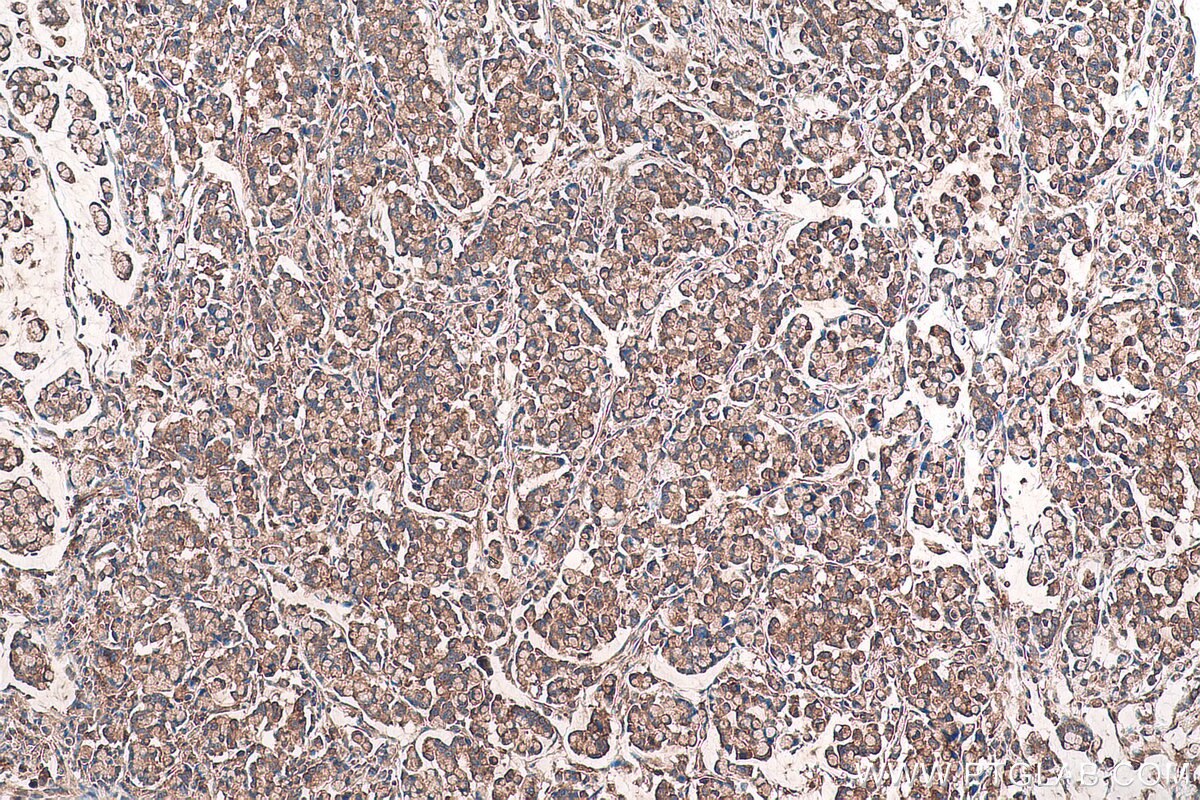 Immunohistochemical analysis of paraffin-embedded human colon cancer tissue slide using KHC0961 (VPS26A IHC Kit).