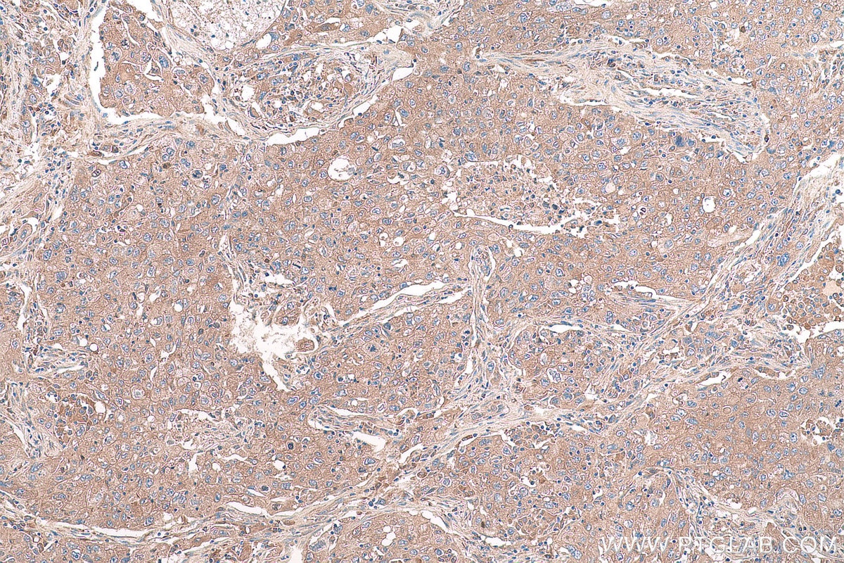Immunohistochemical analysis of paraffin-embedded human lung cancer tissue slide using KHC0961 (VPS26A IHC Kit).