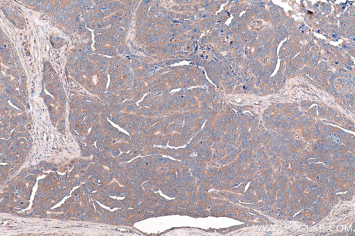 Immunohistochemical analysis of paraffin-embedded human ovary tumor tissue slide using KHC0961 (VPS26A IHC Kit).