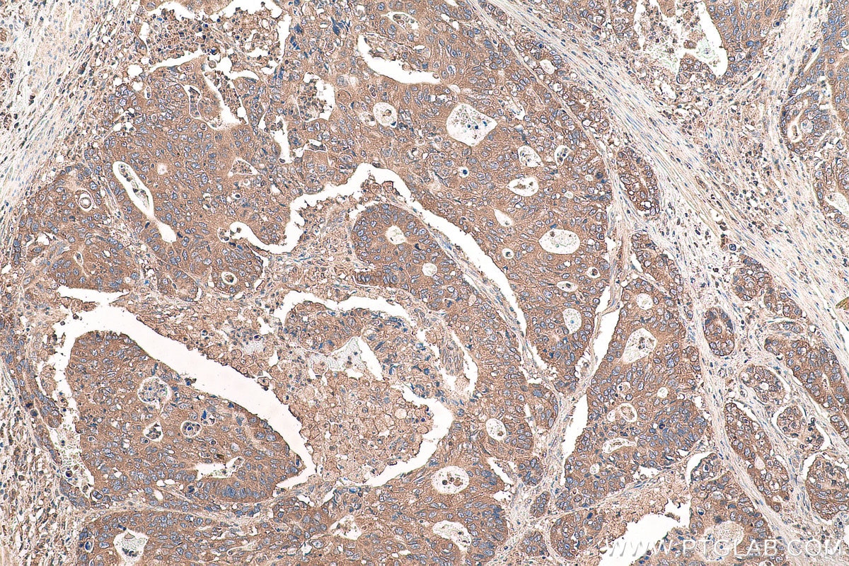 Immunohistochemical analysis of paraffin-embedded human stomach cancer tissue slide using KHC0961 (VPS26A IHC Kit).