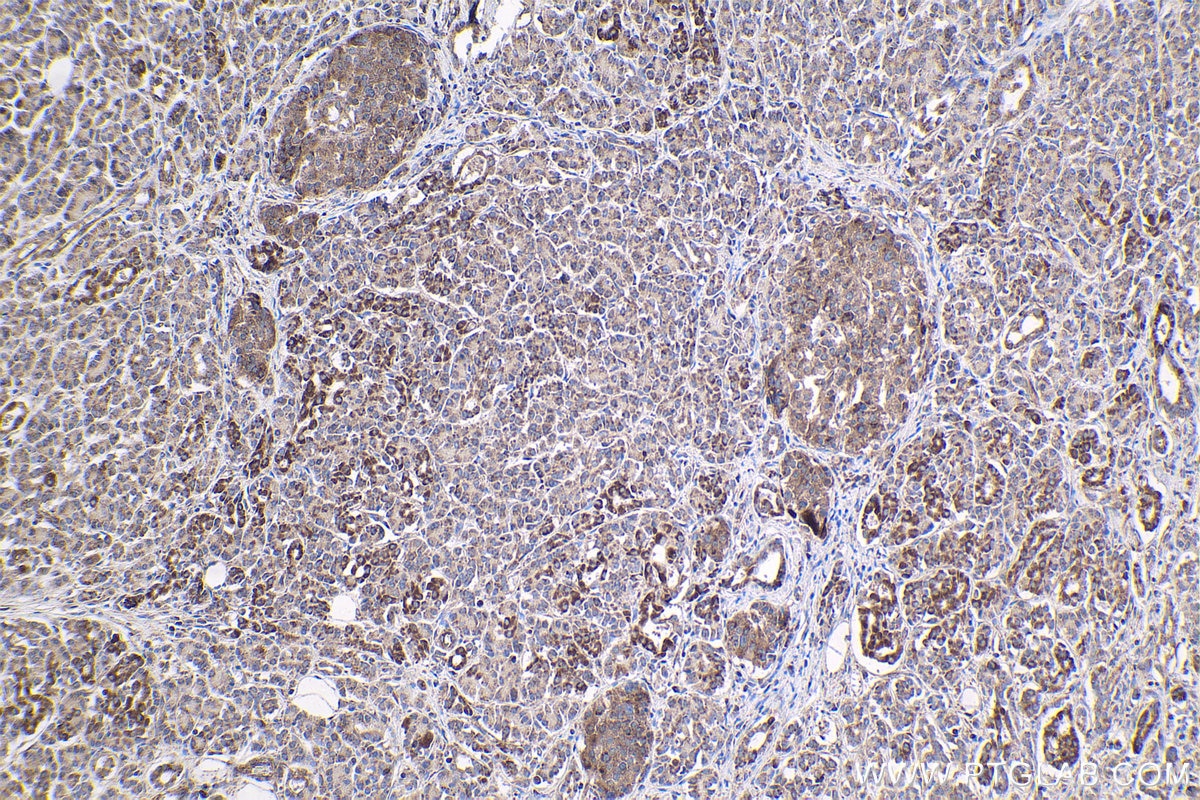 Immunohistochemical analysis of paraffin-embedded human pancreas cancer tissue slide using KHC1809 (VPS36 IHC Kit).