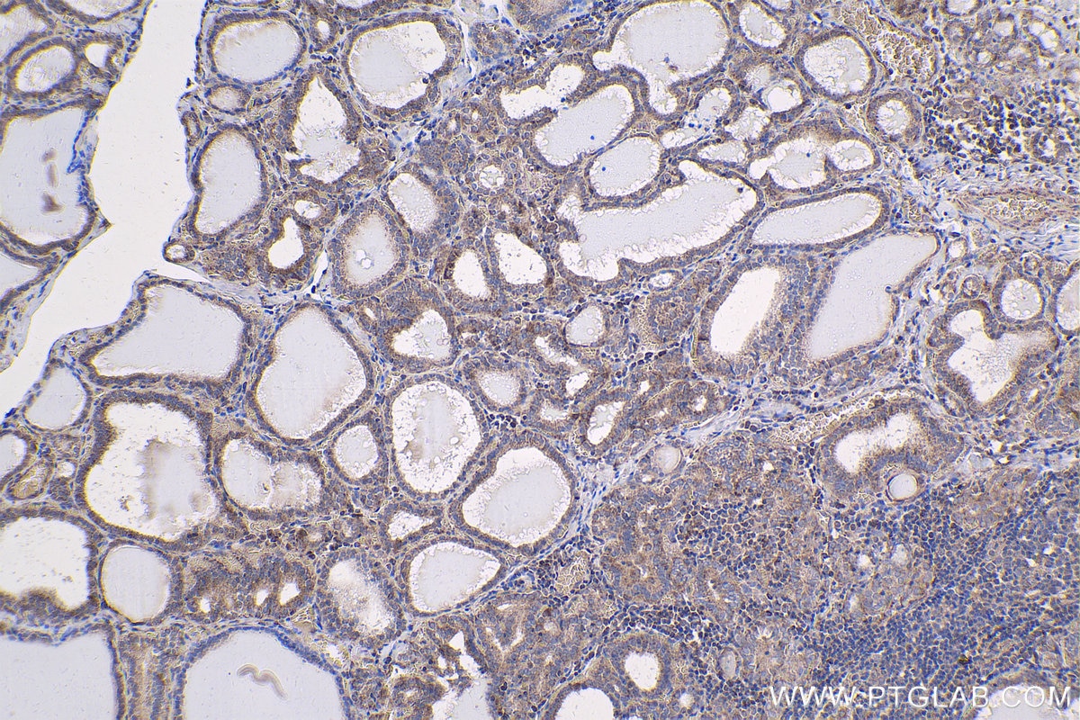 Immunohistochemical analysis of paraffin-embedded human thyroid cancer tissue slide using KHC1809 (VPS36 IHC Kit).