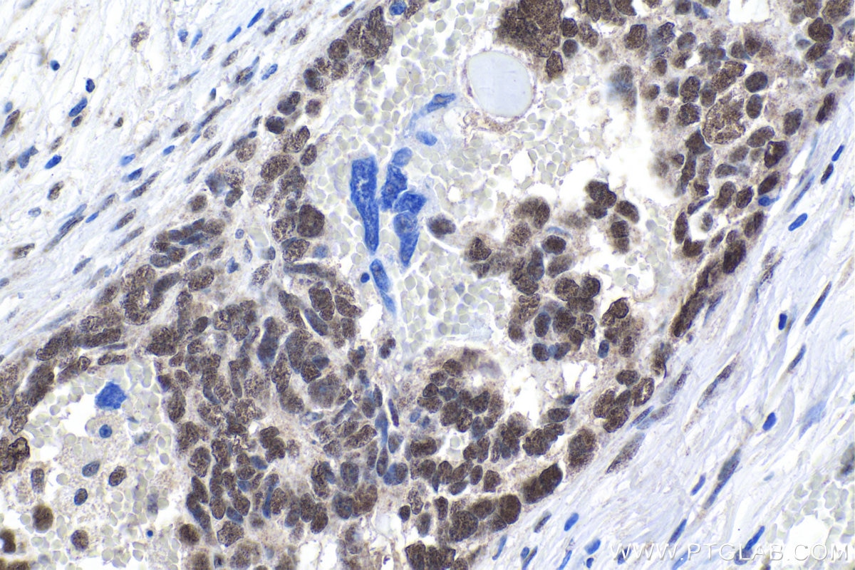Immunohistochemical analysis of paraffin-embedded human ovary tumor tissue slide using KHC1756 (VPS72 IHC Kit).