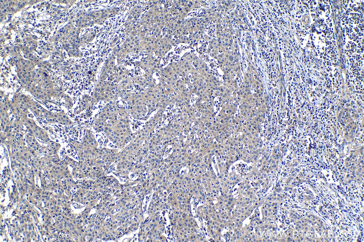 Immunohistochemical analysis of paraffin-embedded human cervical cancer tissue slide using KHC1224 (VTCN1 IHC Kit).