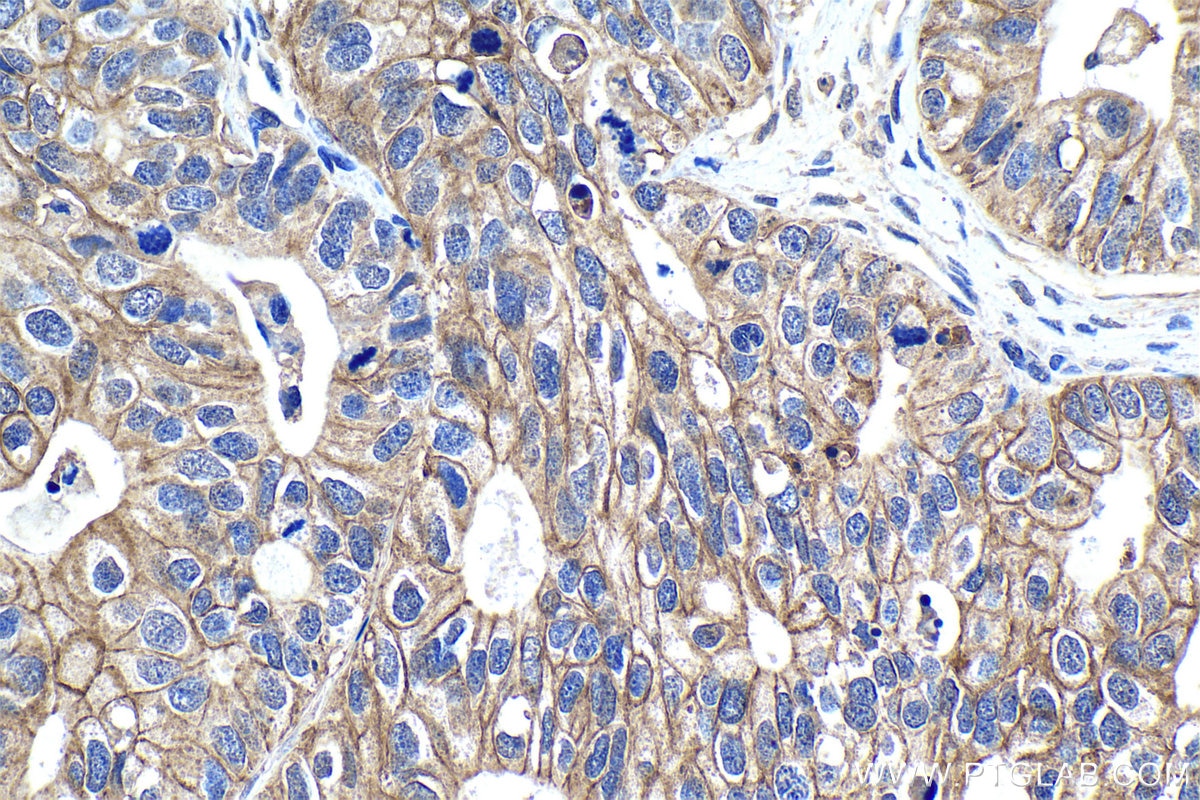Immunohistochemical analysis of paraffin-embedded human ovary tumor tissue slide using KHC1224 (VTCN1 IHC Kit).