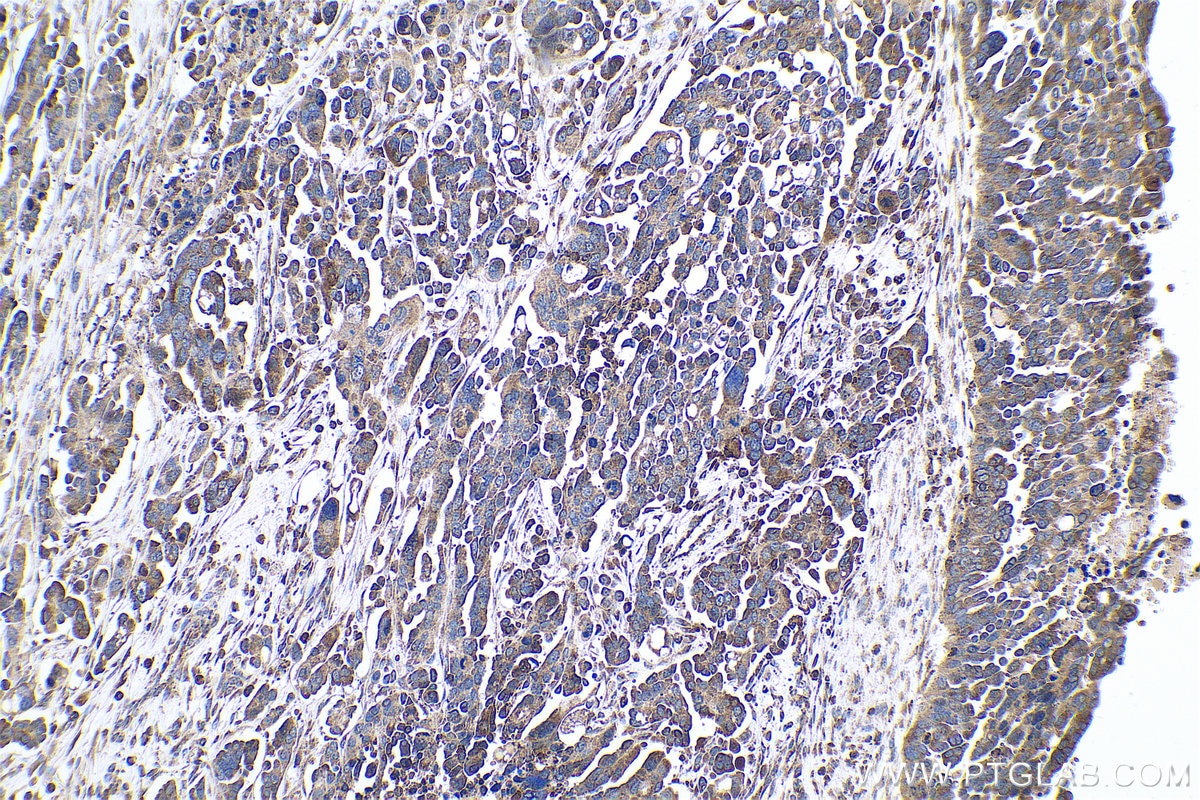 Immunohistochemical analysis of paraffin-embedded human colon cancer tissue slide using KHC0777 (VWA2 IHC Kit).