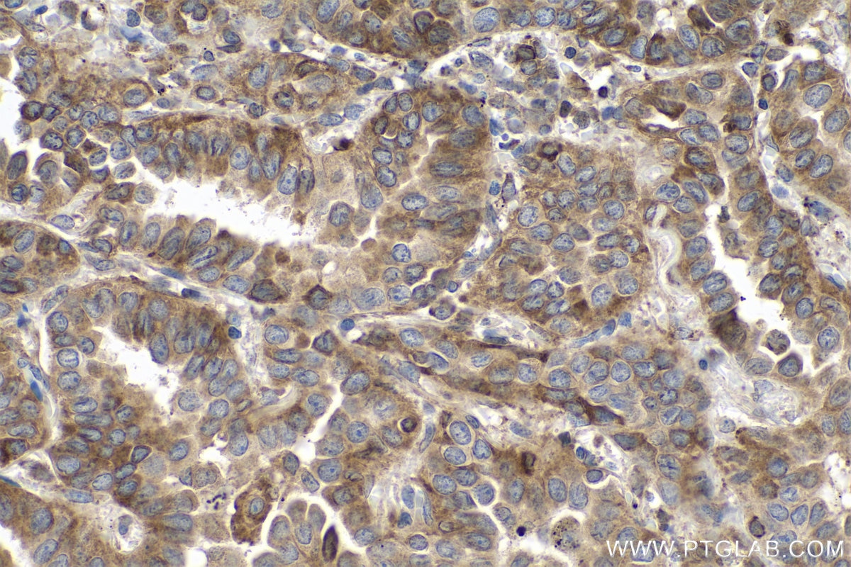 Immunohistochemical analysis of paraffin-embedded human lung cancer tissue slide using KHC0777 (VWA2 IHC Kit).