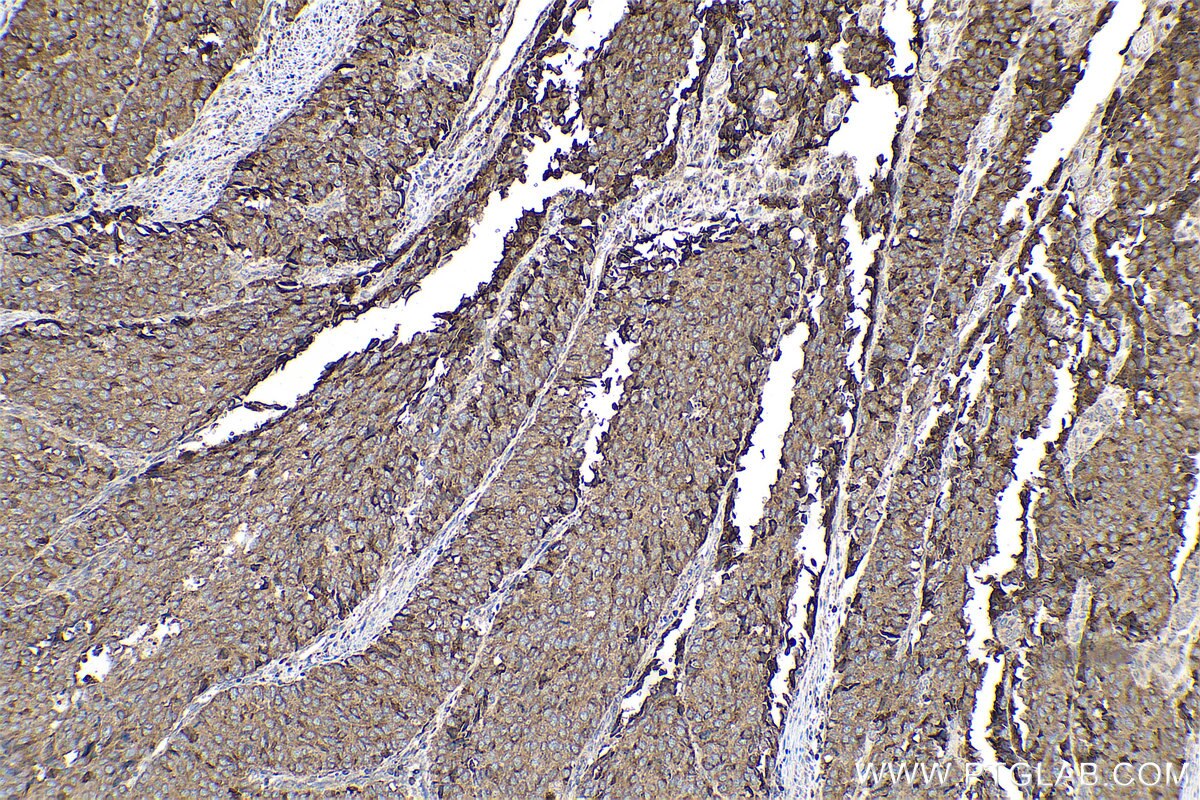 Immunohistochemical analysis of paraffin-embedded human stomach cancer tissue slide using KHC0777 (VWA2 IHC Kit).