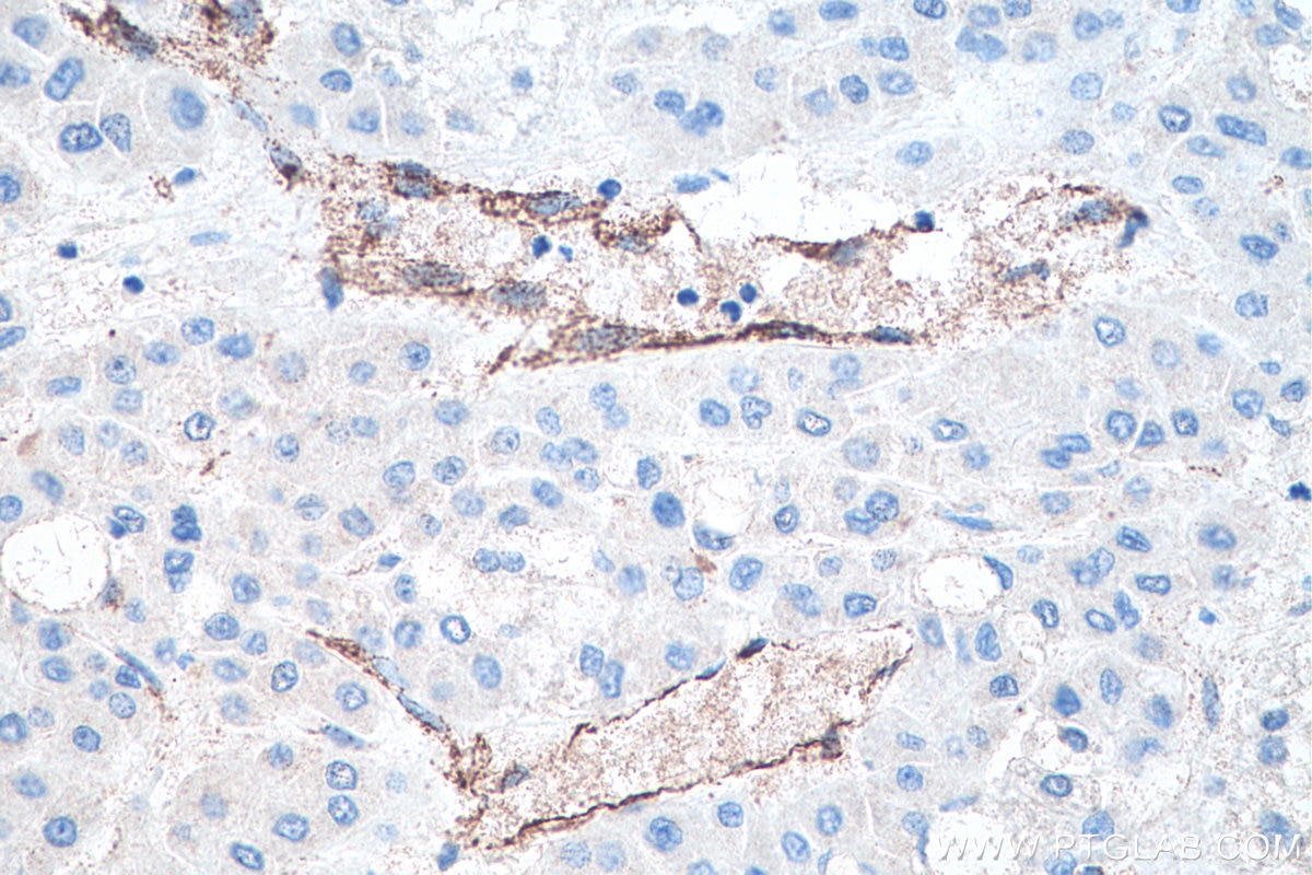 Immunohistochemical analysis of paraffin-embedded human liver cancer tissue slide using KHC0209 (VWF IHC Kit).