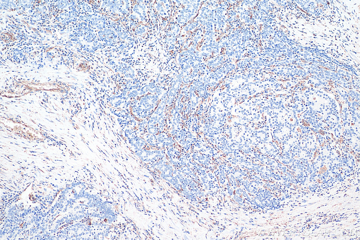 Immunohistochemical analysis of paraffin-embedded human colon cancer tissue slide using KHC0039 (Vimentin IHC Kit).