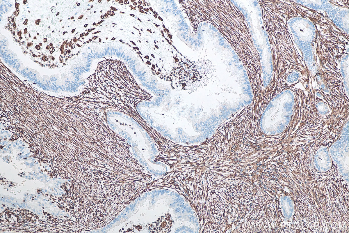 Immunohistochemical analysis of paraffin-embedded human pancreas cancer tissue slide using KHC0039 (Vimentin IHC Kit).