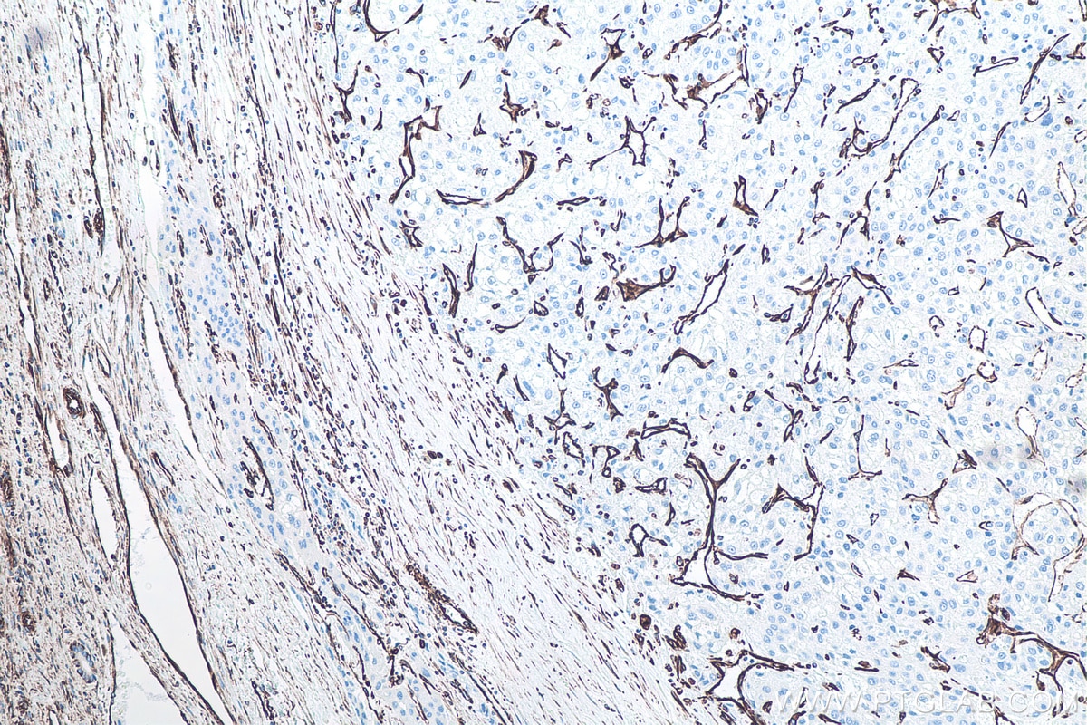 Immunohistochemical analysis of paraffin-embedded human liver cancer tissue slide using KHC0039 (Vimentin IHC Kit).