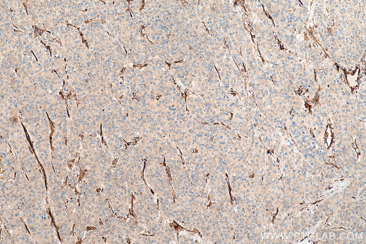 Immunohistochemical analysis of paraffin-embedded human liver cancer tissue slide using KHC0718 (WARS IHC Kit).