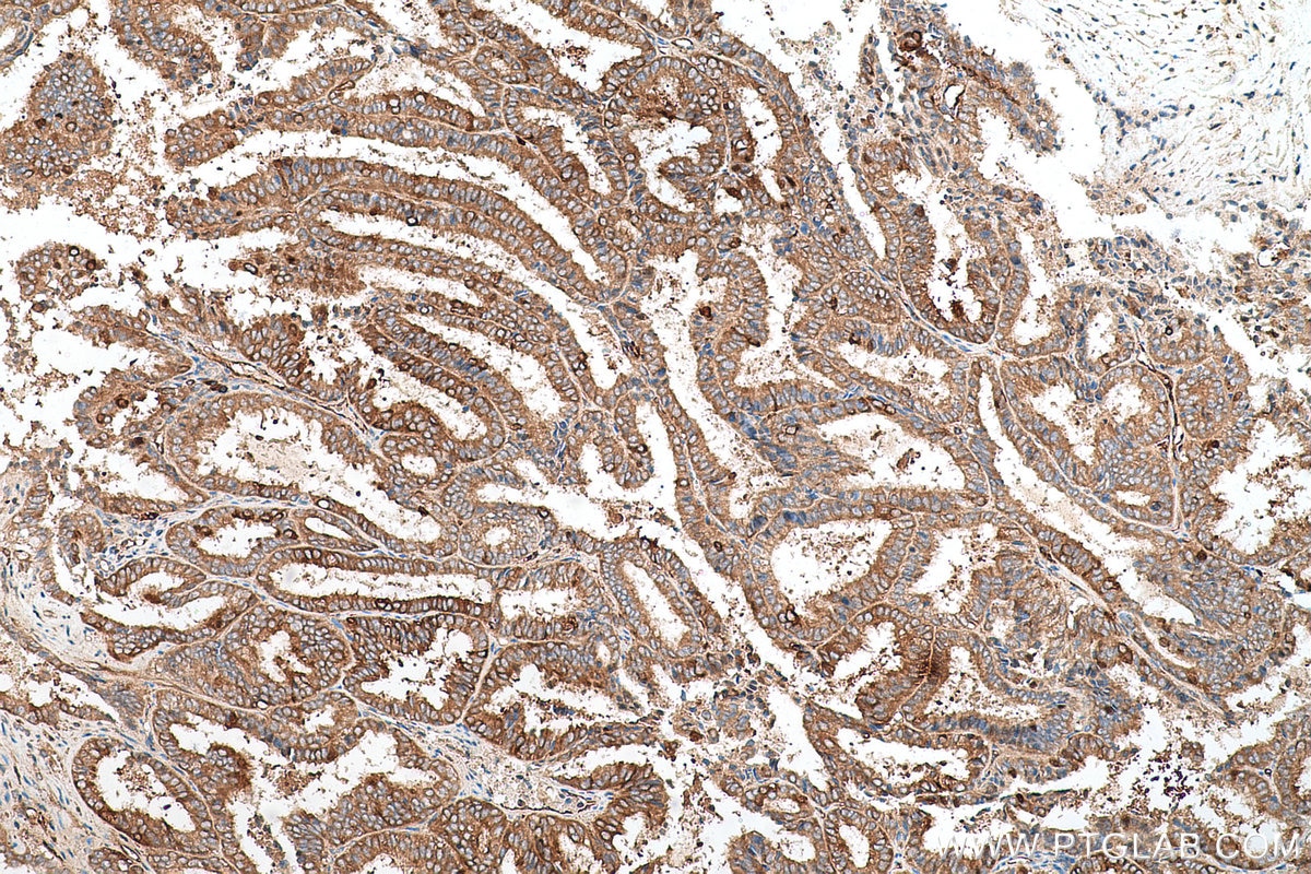 Immunohistochemical analysis of paraffin-embedded human ovary tumor tissue slide using KHC0718 (WARS IHC Kit).