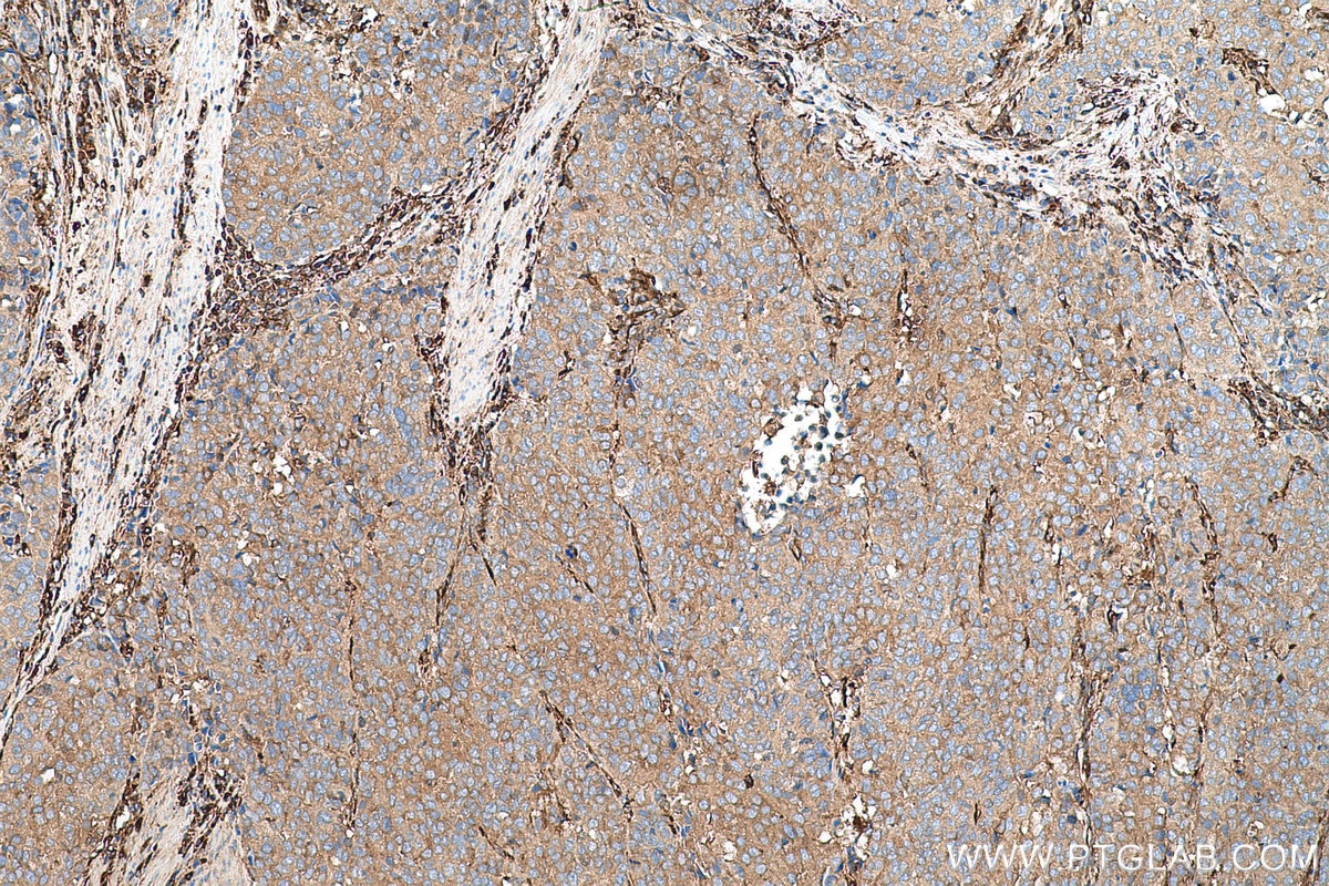 Immunohistochemical analysis of paraffin-embedded human stomach cancer tissue slide using KHC0718 (WARS IHC Kit).