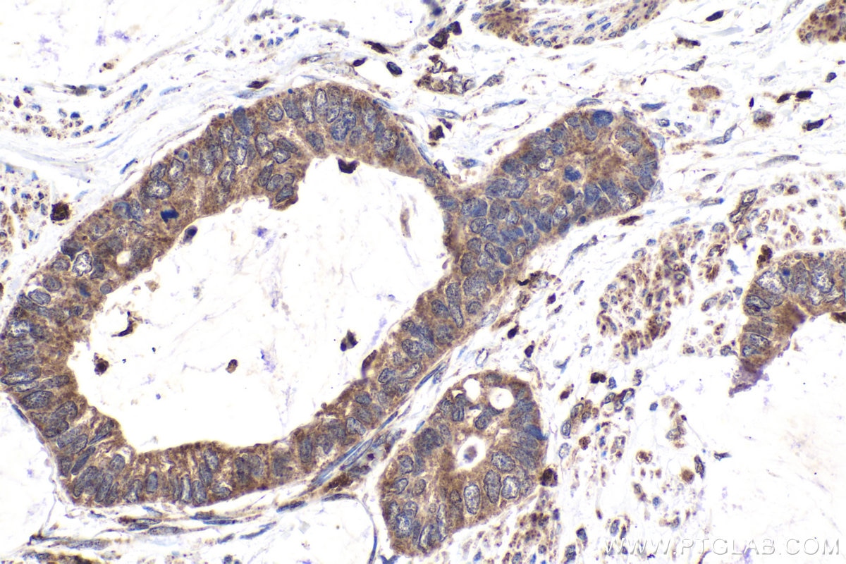 Immunohistochemical analysis of paraffin-embedded human urothelial carcinoma tissue slide using KHC1596 (WAS IHC Kit).