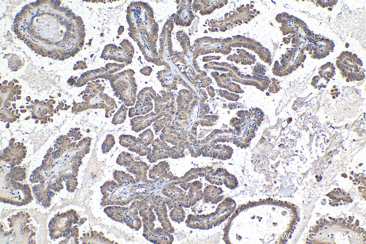 Immunohistochemical analysis of paraffin-embedded human thyroid cancer tissue slide using KHC1422 (WASL IHC Kit).